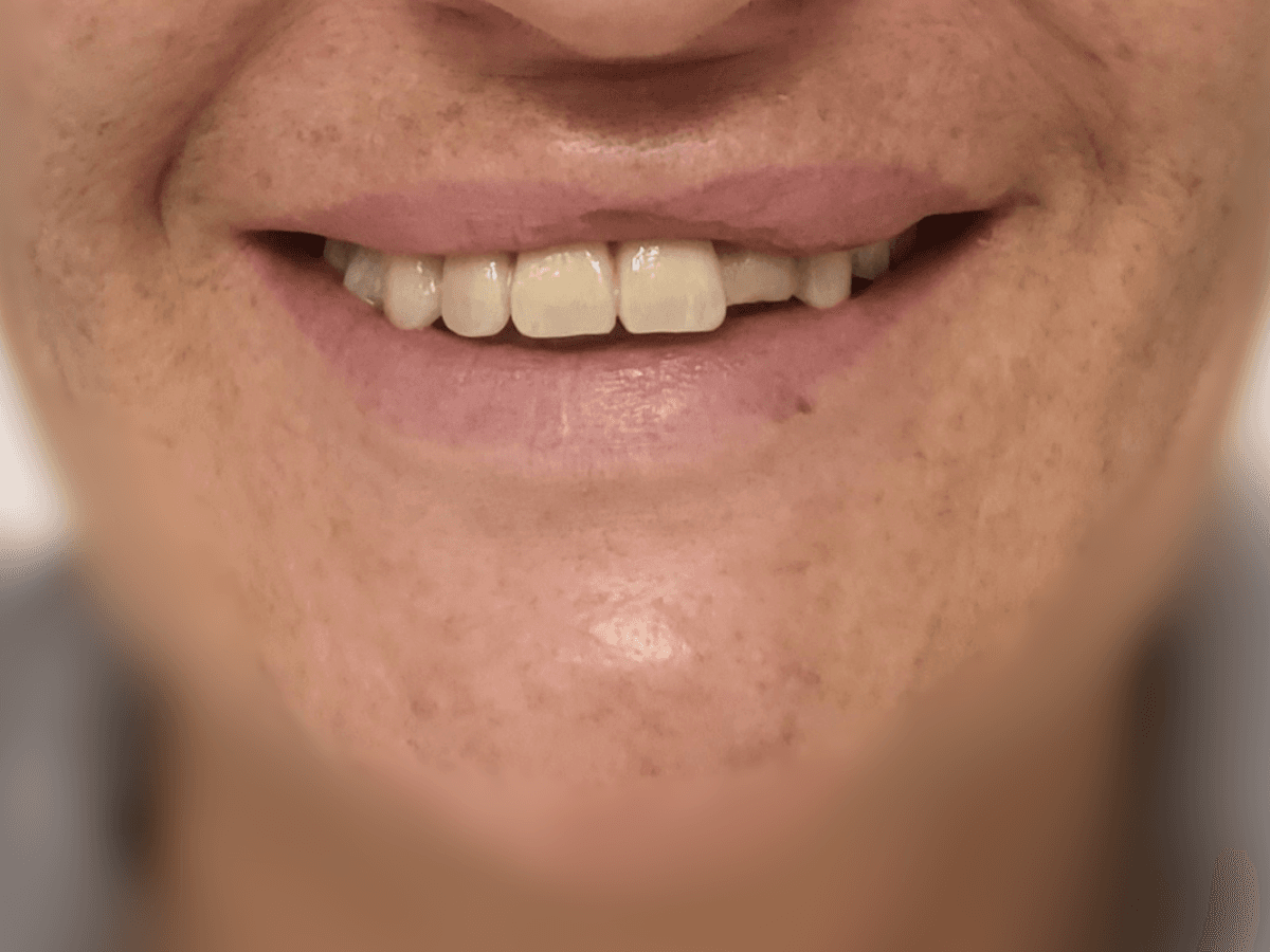 Antes de Implantes 3D - Dra. Laura Delgado Neuquén