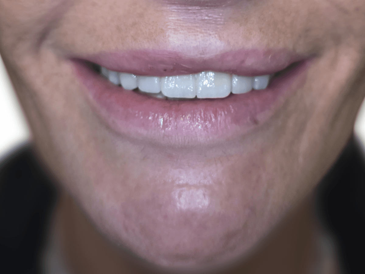 Resultado después de Implantes 3D - Dra. Laura Delgado Neuquén