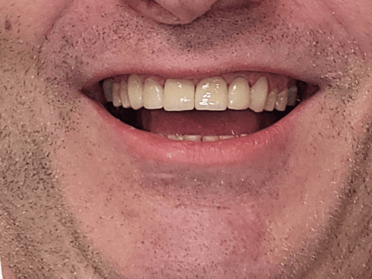 Resultado después de Carillas cerámicas - Dra. Laura Delgado Neuquén