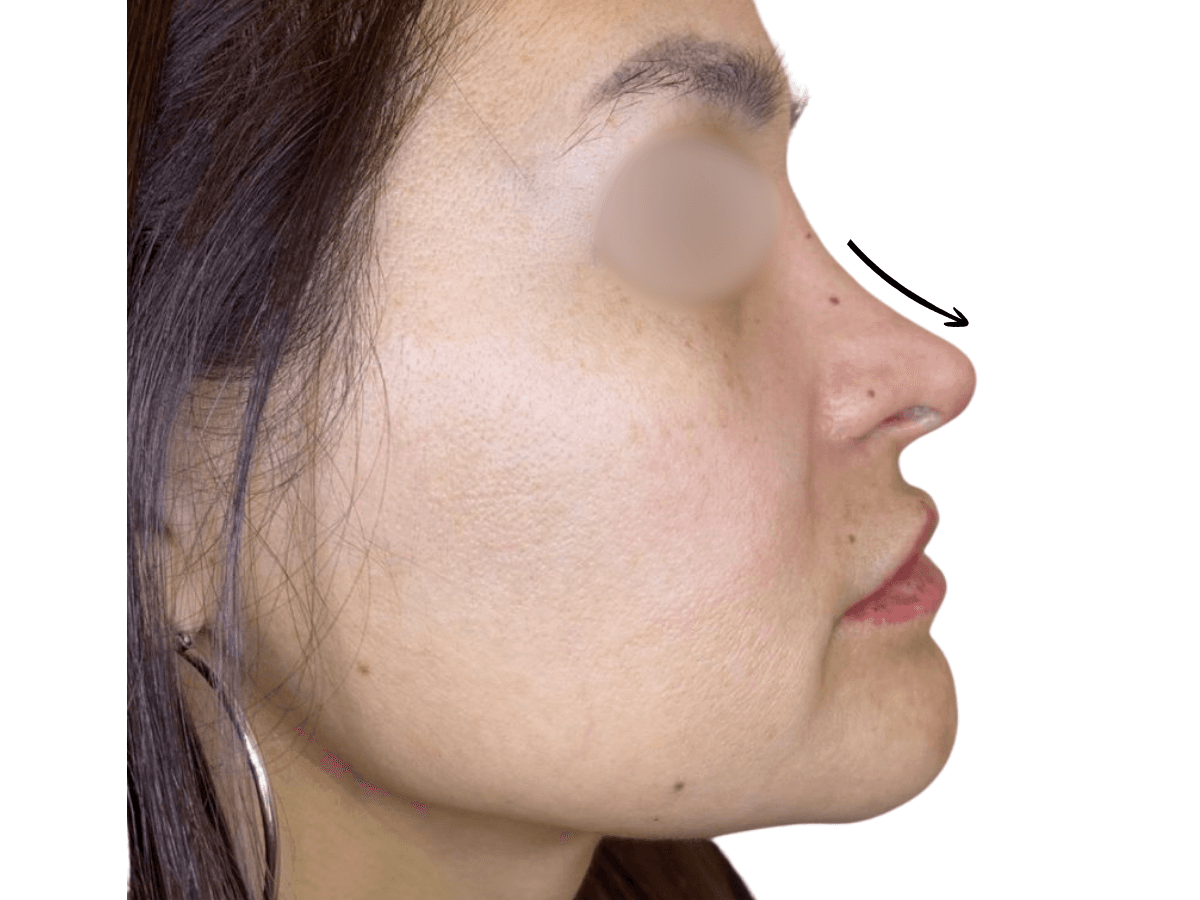Resultado después de Rino y perfilado natural de labios - Dra. Laura Delgado Neuquén